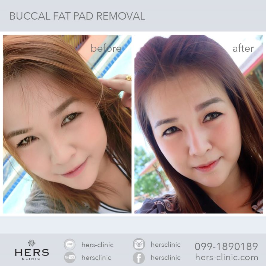 ตัดไขมันกระพุ้งแก้ม ลดแก้ม หน้าเรียว Hers Clinic