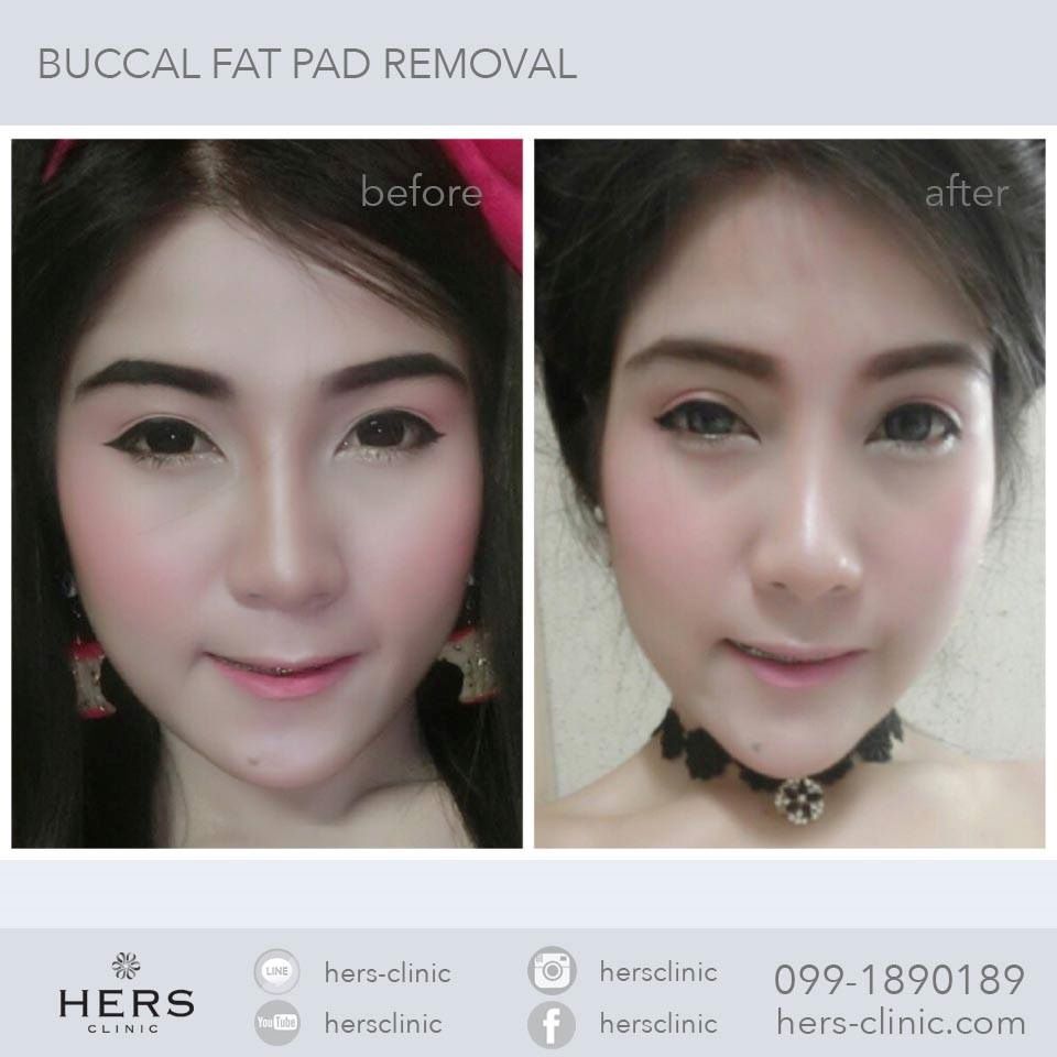 ตัดไขมันกระพุ้งแก้ม ลดแก้ม หน้าเรียว Hers Clinic