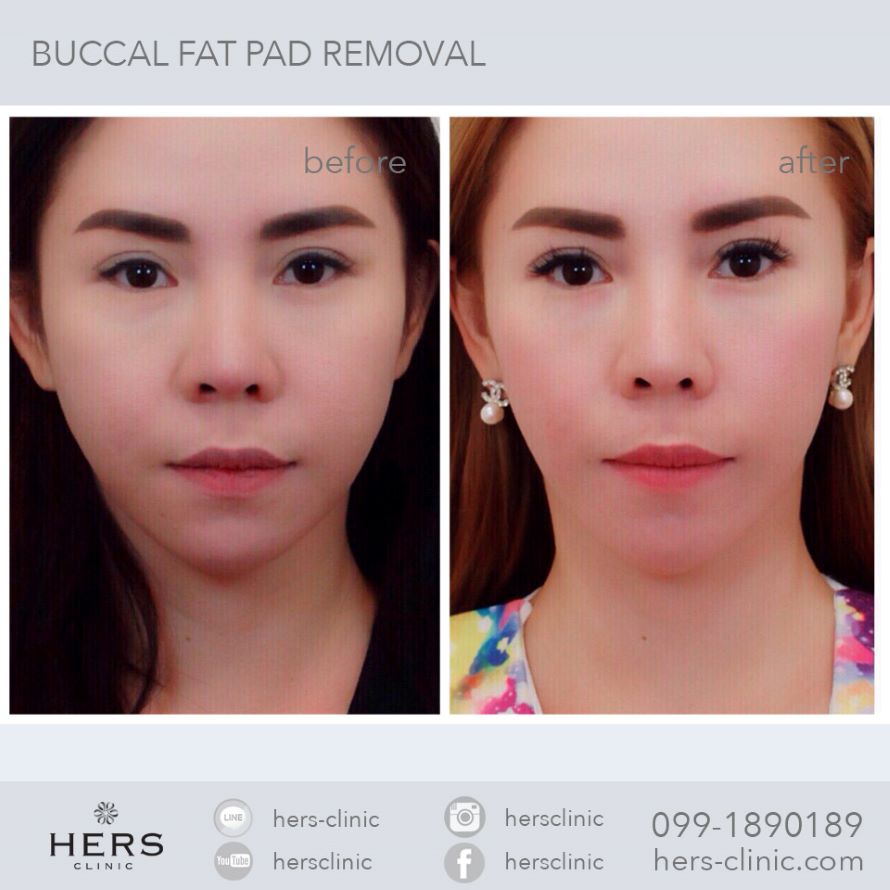 ตัดไขมันกระพุ้งแก้ม ลดแก้ม หน้าเรียว Hers Clinic
