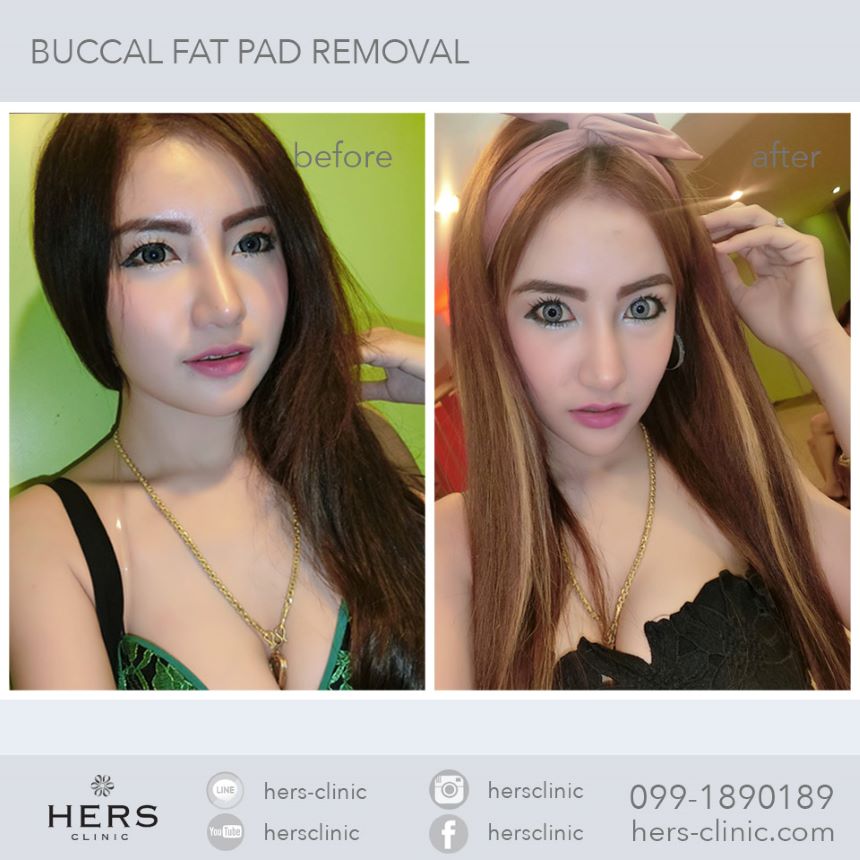 ตัดไขมันกระพุ้งแก้ม ลดแก้ม หน้าเรียว Hers Clinic