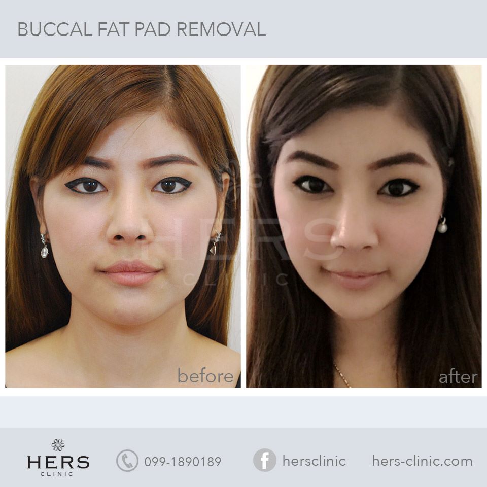 ตัดไขมันกระพุ้งแก้ม ลดแก้ม หน้าเรียว Hers Clinic