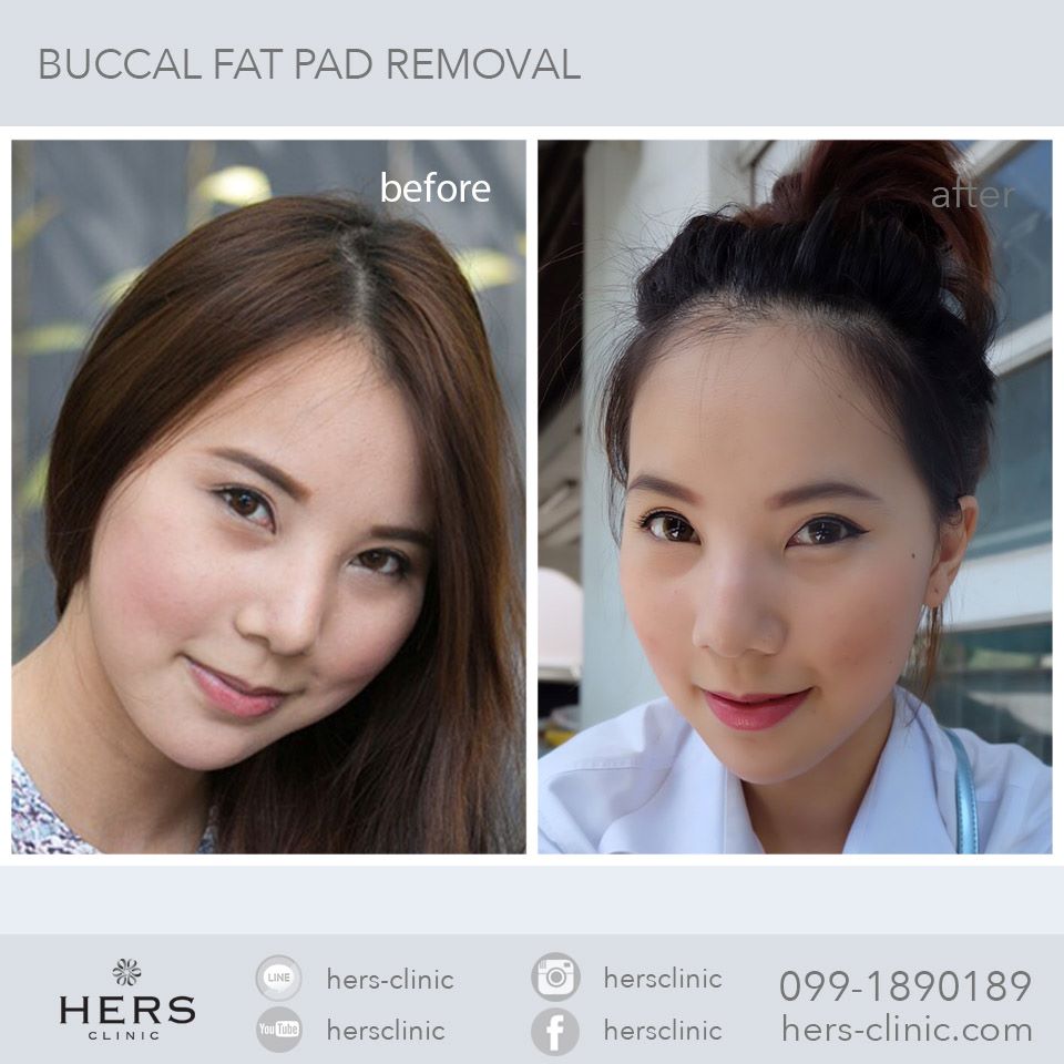 ตัดไขมันกระพุ้งแก้ม ลดแก้ม หน้าเรียว Hers Clinic