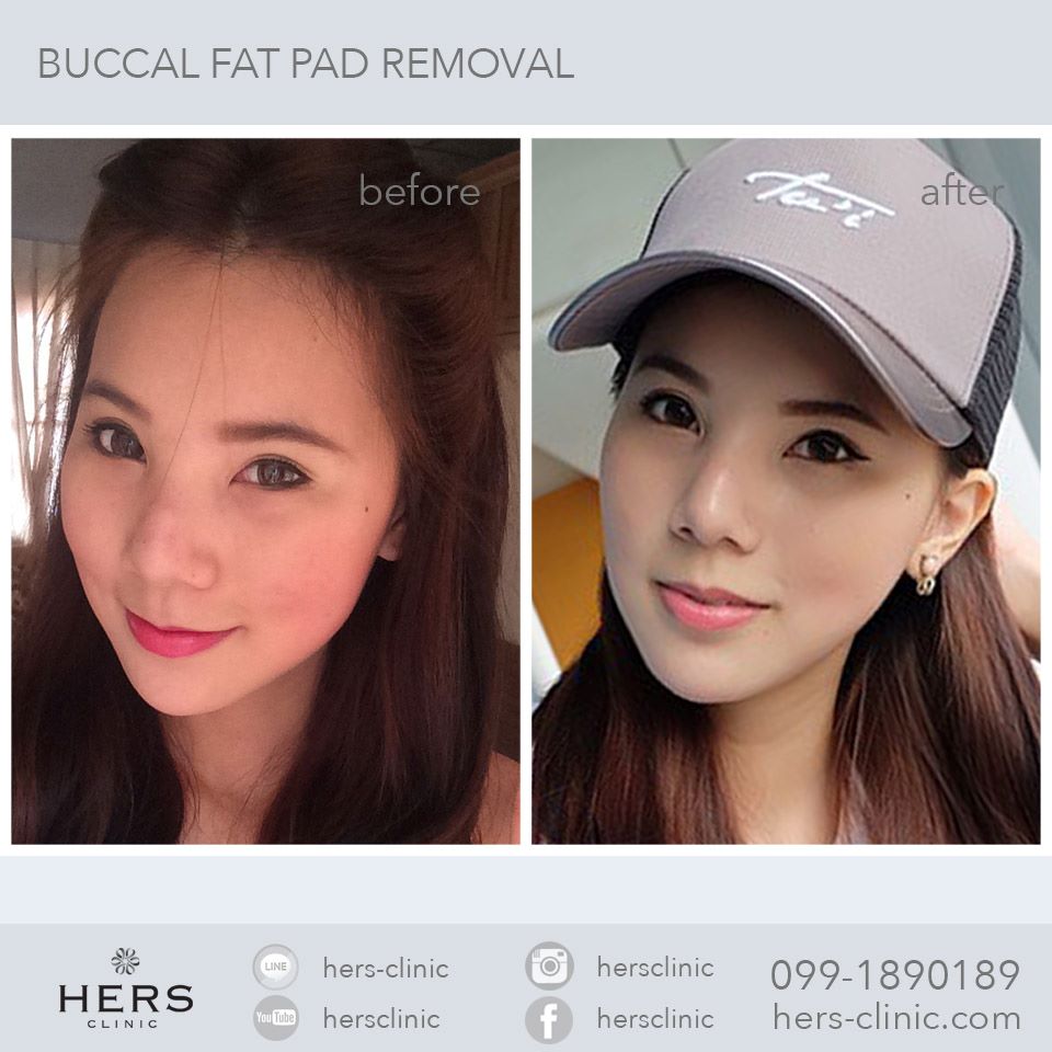 ตัดไขมันกระพุ้งแก้ม ลดแก้ม หน้าเรียว Hers Clinic