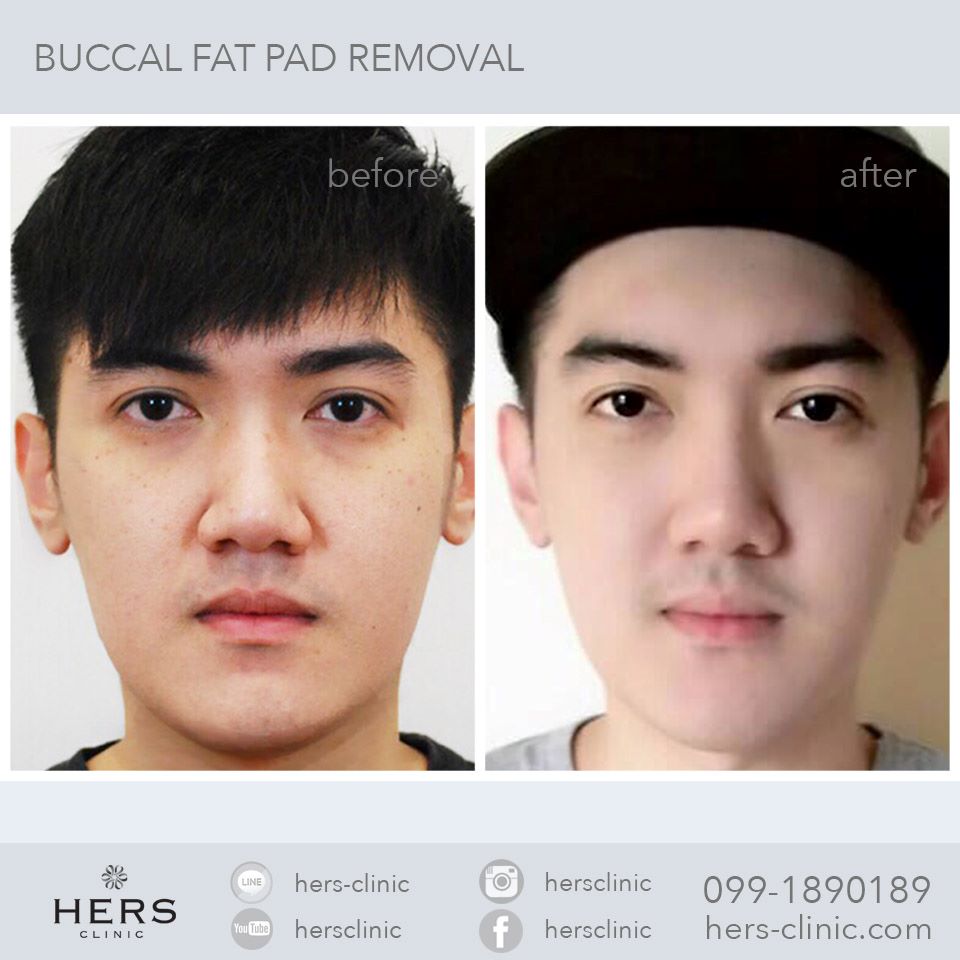 ตัดไขมันกระพุ้งแก้ม ลดแก้ม หน้าเรียว Hers Clinic