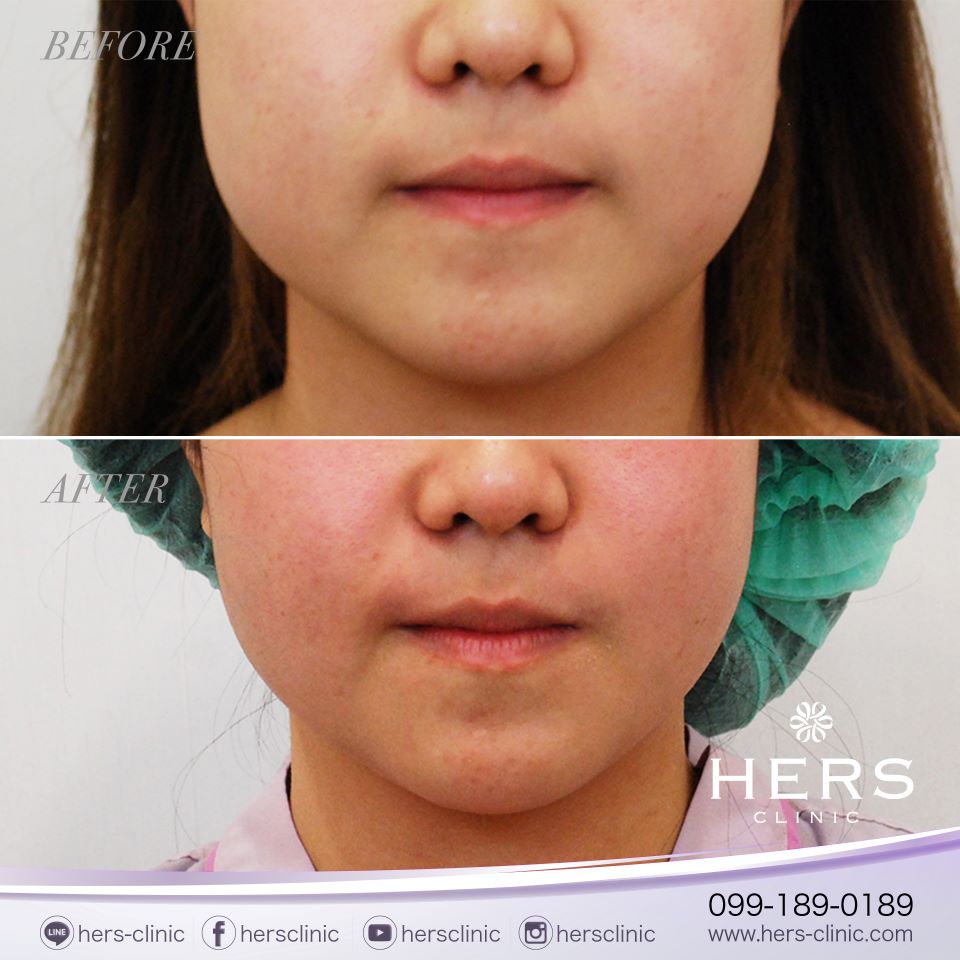 ตัดไขมันกระพุ้งแก้ม ลดแก้ม หน้าเรียว Hers Clinic