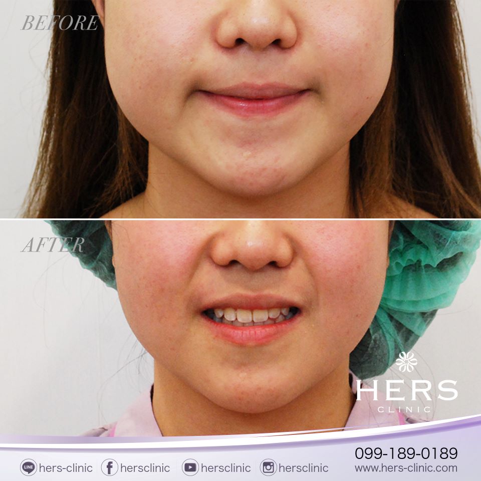 ตัดไขมันกระพุ้งแก้ม ลดแก้ม หน้าเรียว Hers Clinic