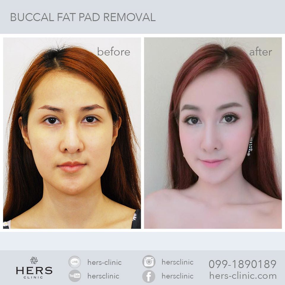 ตัดไขมันกระพุ้งแก้ม ลดแก้ม หน้าเรียว Hers Clinic