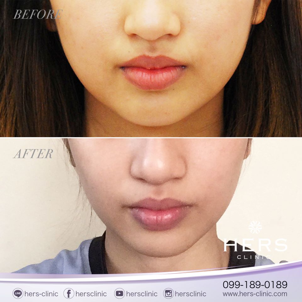 ตัดไขมันกระพุ้งแก้ม ลดแก้ม หน้าเรียว Hers Clinic