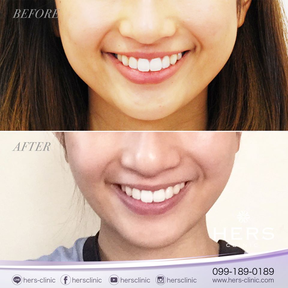 ตัดไขมันกระพุ้งแก้ม ลดแก้ม หน้าเรียว Hers Clinic