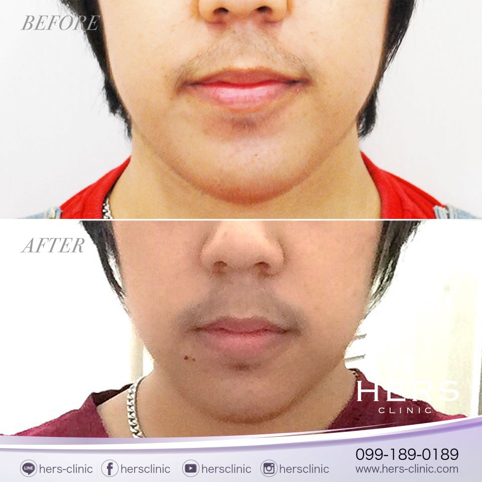 ตัดไขมันกระพุ้งแก้ม ลดแก้ม หน้าเรียว Hers Clinic