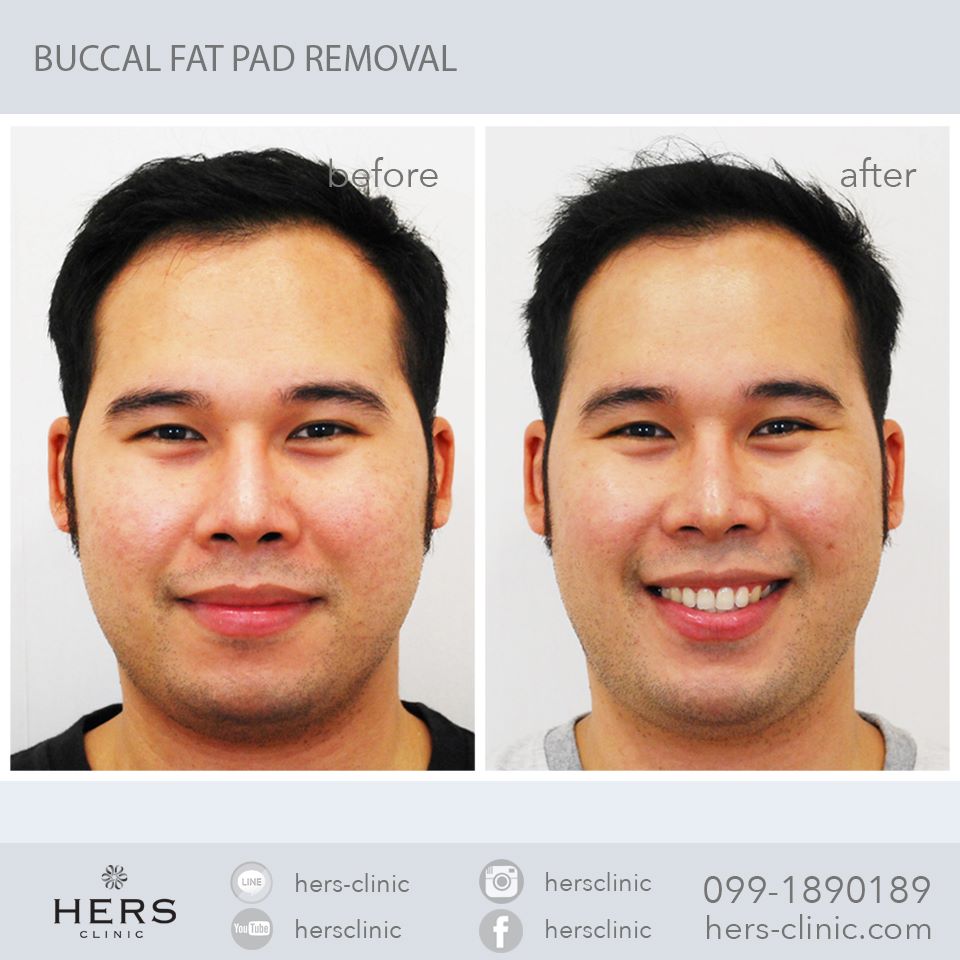 ตัดไขมันกระพุ้งแก้ม ลดแก้ม หน้าเรียว Hers Clinic