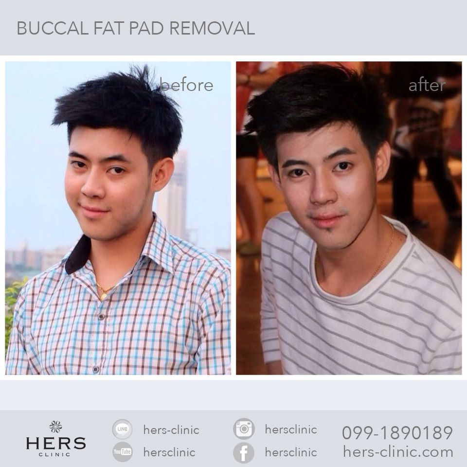 ตัดไขมันกระพุ้งแก้ม ลดแก้ม หน้าเรียว Hers Clinic