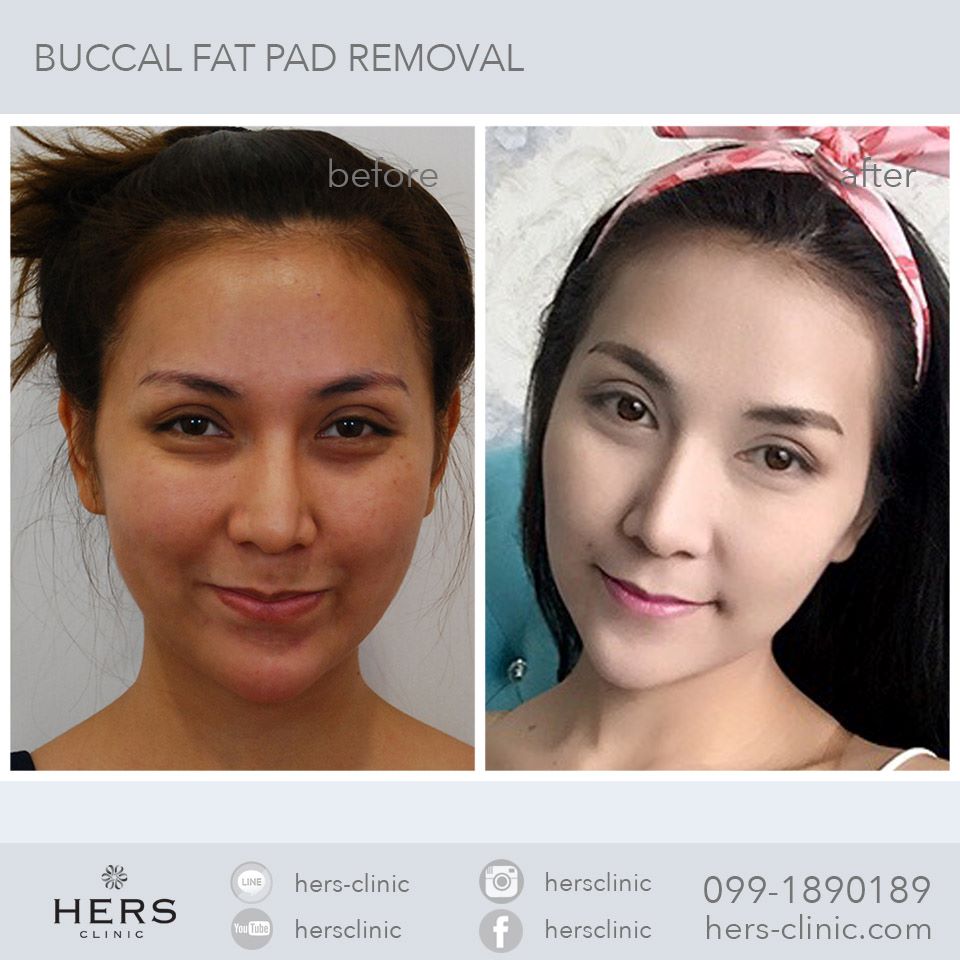 ตัดไขมันกระพุ้งแก้ม ลดแก้ม หน้าเรียว Hers Clinic