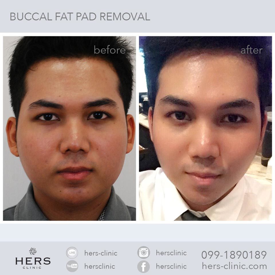 ตัดไขมันกระพุ้งแก้ม ลดแก้ม หน้าเรียว Hers Clinic