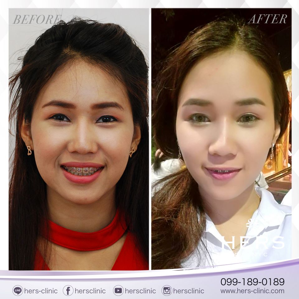 ตัดไขมันกระพุ้งแก้ม ลดแก้ม หน้าเรียว Hers Clinic