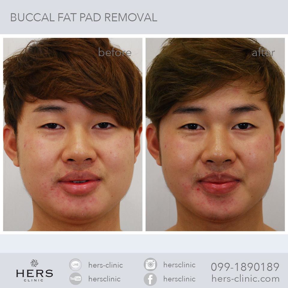 ตัดไขมันกระพุ้งแก้ม ลดแก้ม หน้าเรียว Hers Clinic