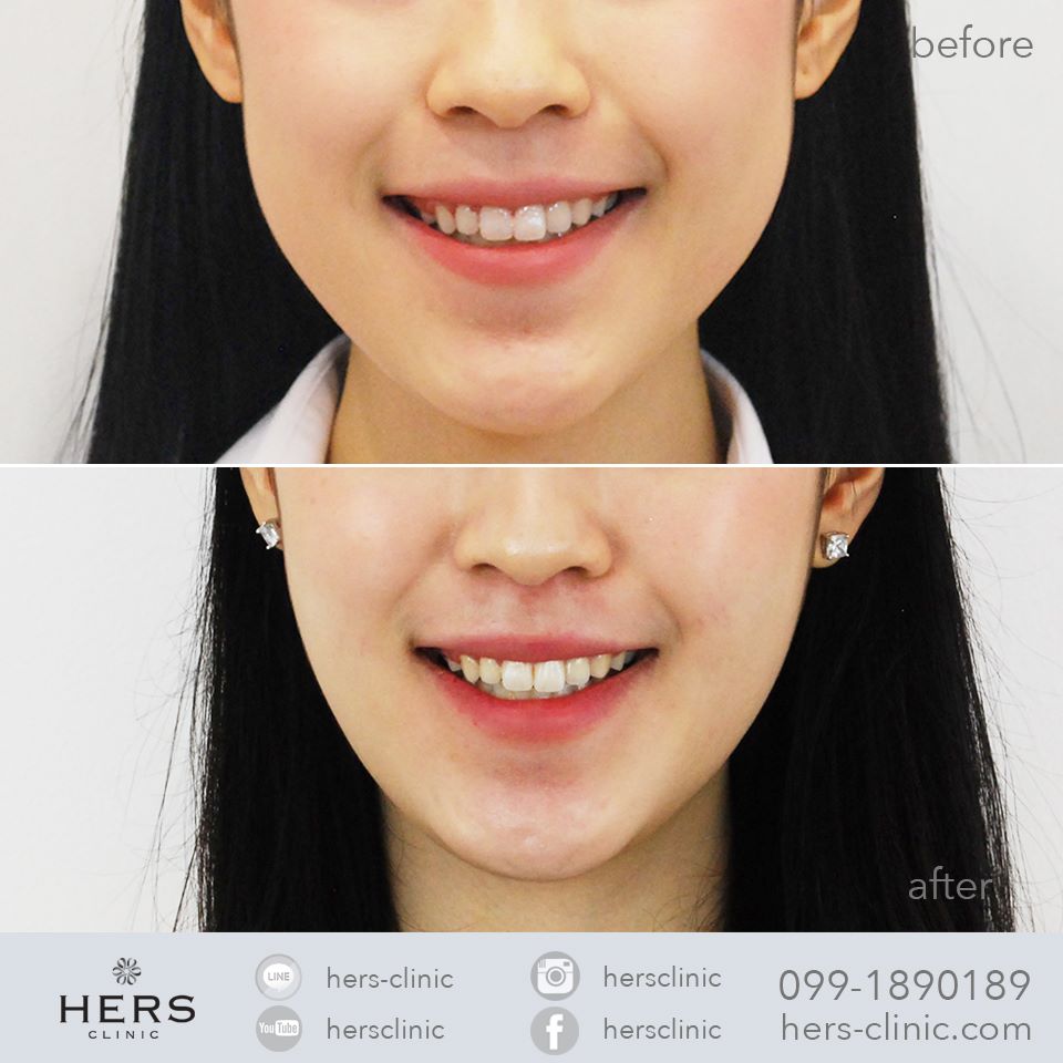 ตัดไขมันกระพุ้งแก้ม ลดแก้ม หน้าเรียว Hers Clinic