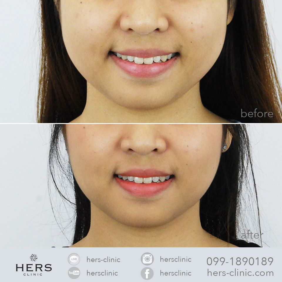 ตัดไขมันกระพุ้งแก้ม ลดแก้ม หน้าเรียว Hers Clinic