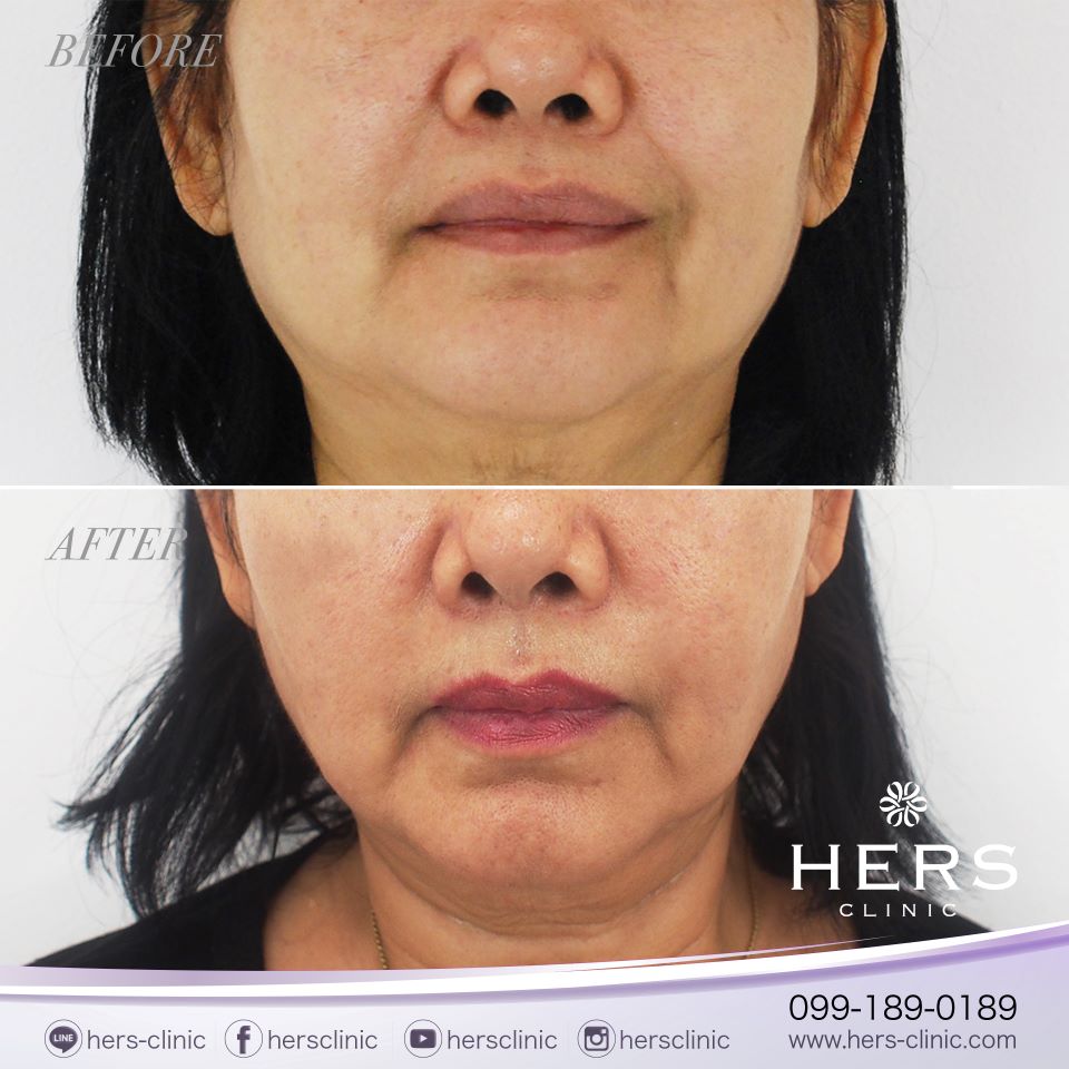 ตัดไขมันกระพุ้งแก้ม ลดแก้ม หน้าเรียว Hers Clinic