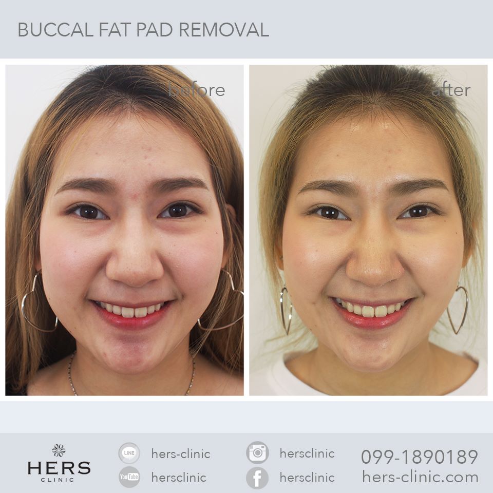 ตัดไขมันกระพุ้งแก้ม ลดแก้ม หน้าเรียว Hers Clinic