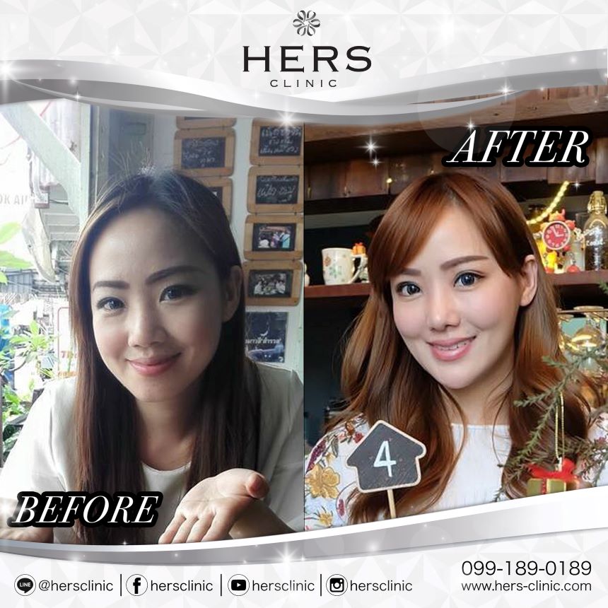 ตัดไขมันกระพุ้งแก้ม ลดแก้ม หน้าเรียว Hers Clinic