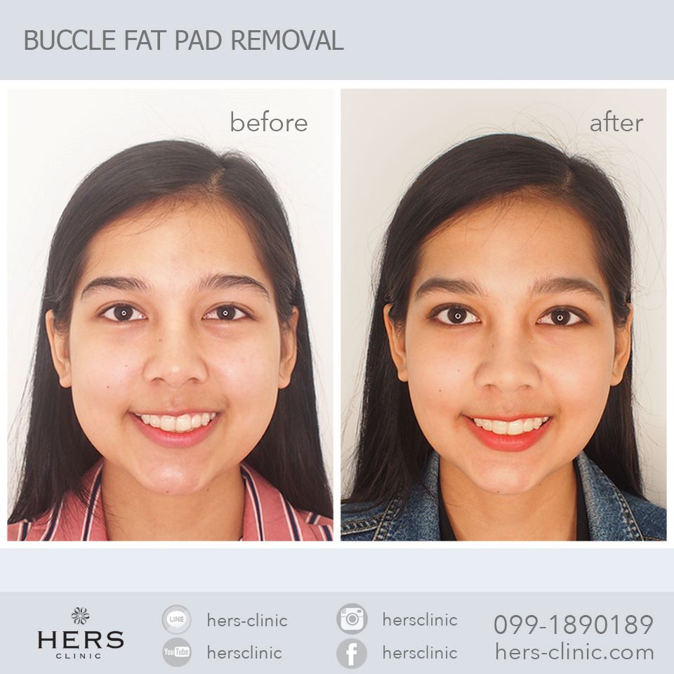 ตัดไขมันกระพุ้งแก้ม ลดแก้ม หน้าเรียว Hers Clinic