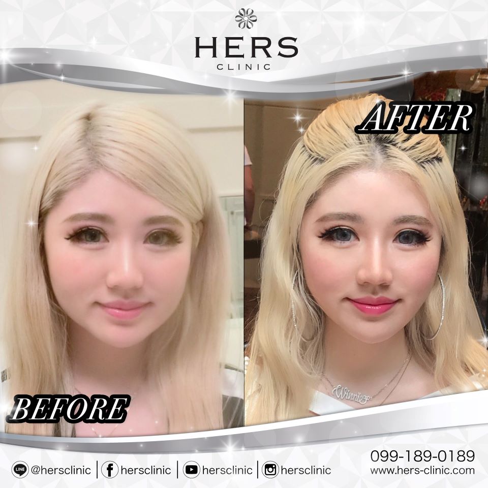 ตัดไขมันกระพุ้งแก้ม ลดแก้ม หน้าเรียว Hers Clinic