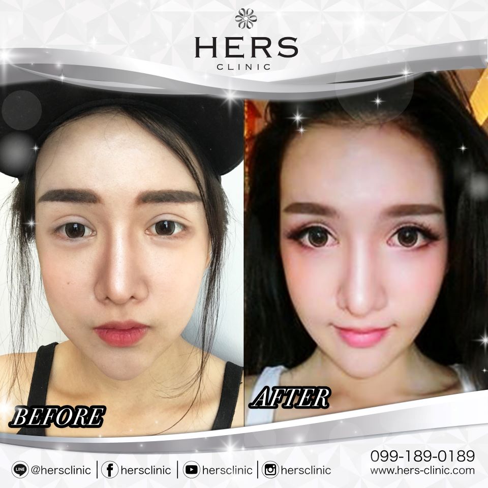 ตัดไขมันกระพุ้งแก้ม ลดแก้ม หน้าเรียว Hers Clinic