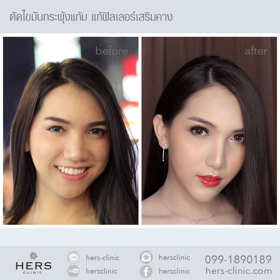 ตัดไขมันกระพุ้งแก้ม ลดแก้ม หน้าเรียว Hers Clinic