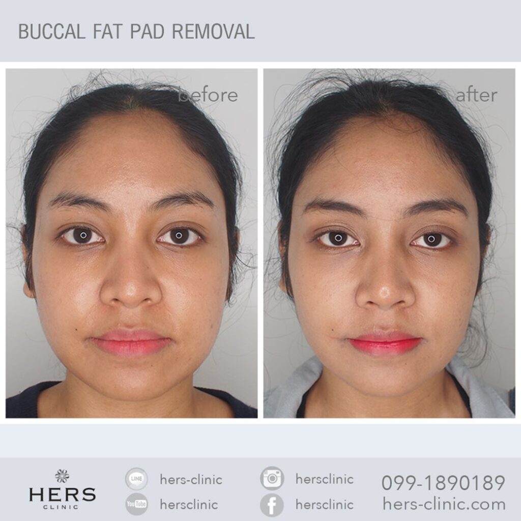 ตัดไขมันกระพุ้งแก้ม ลดแก้ม หน้าเรียว Hers Clinic