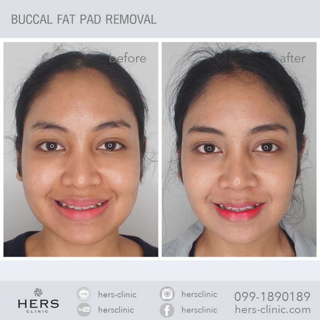 ตัดไขมันกระพุ้งแก้ม ลดแก้ม หน้าเรียว Hers Clinic