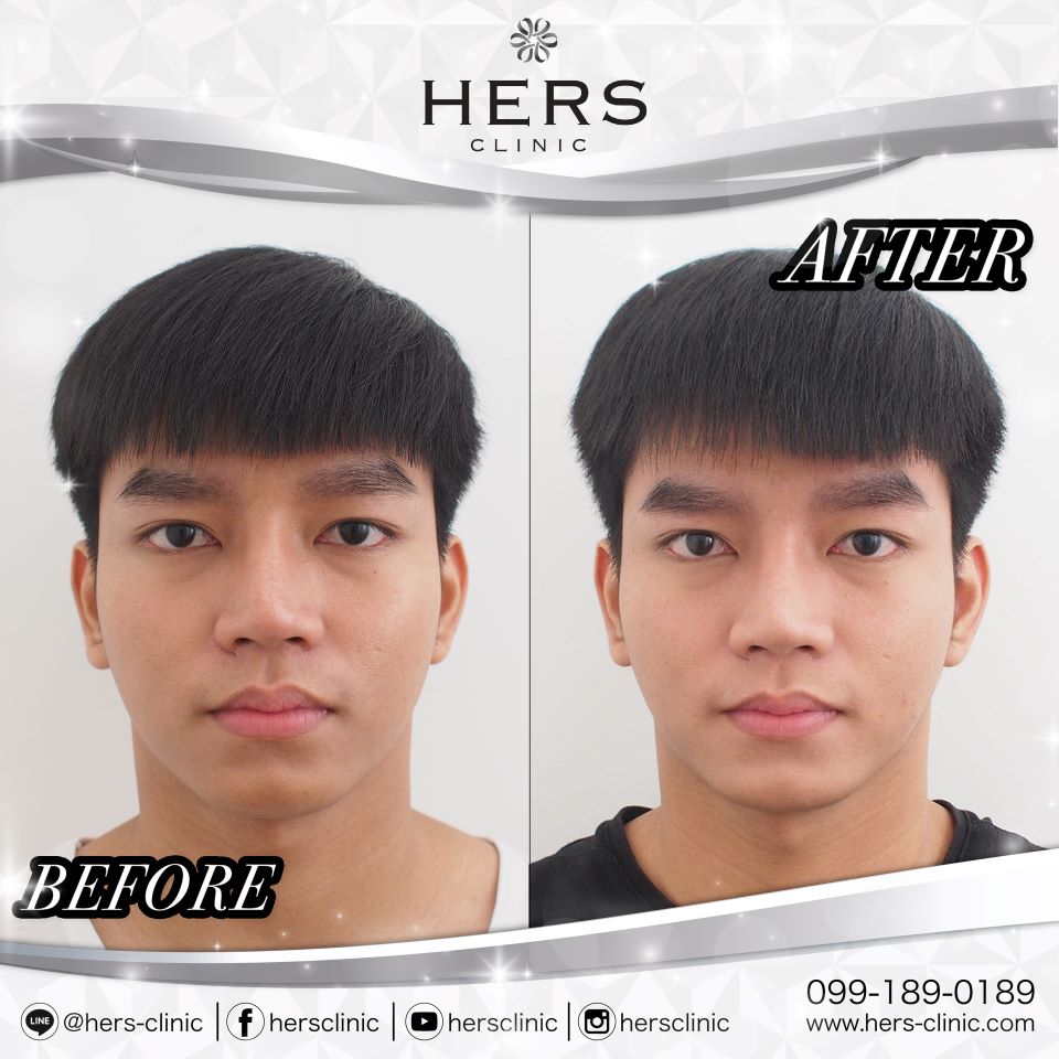 ตัดไขมันกระพุ้งแก้ม ลดแก้ม หน้าเรียว Hers Clinic
