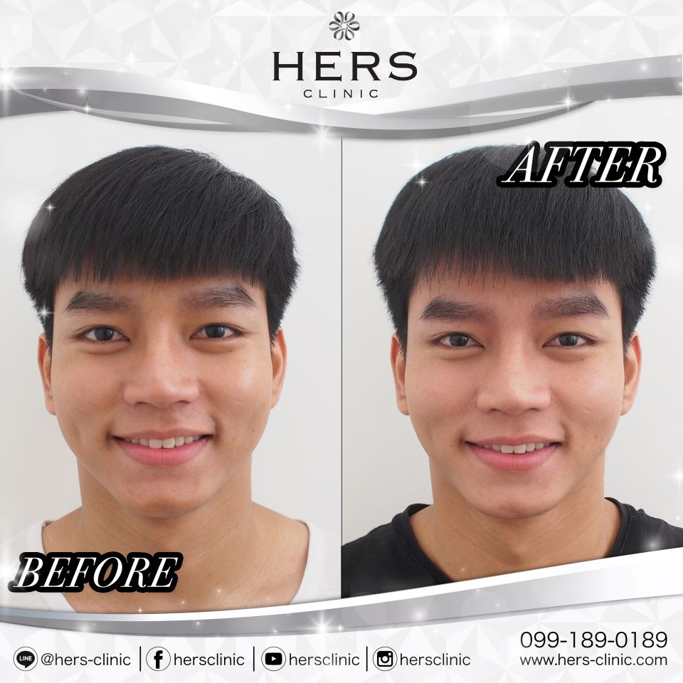 ตัดไขมันกระพุ้งแก้ม ลดแก้ม หน้าเรียว Hers Clinic