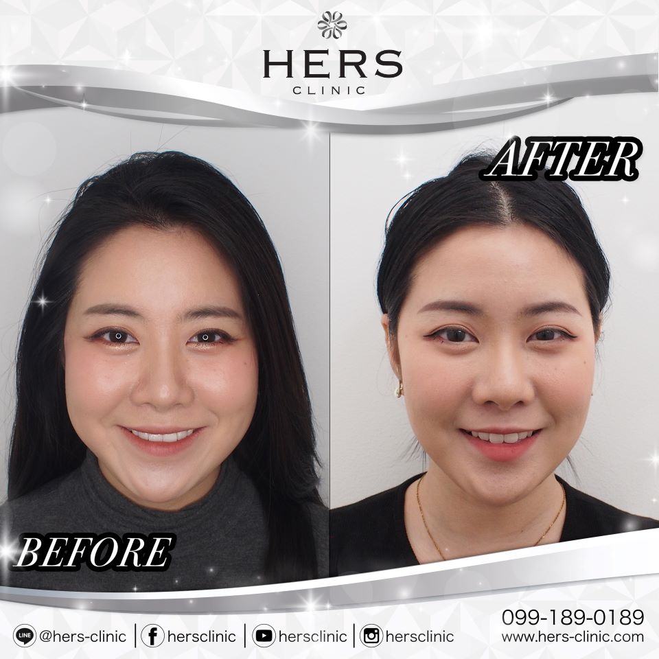 ตัดไขมันกระพุ้งแก้ม ลดแก้ม หน้าเรียว Hers Clinic