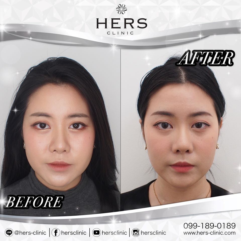 ตัดไขมันกระพุ้งแก้ม ลดแก้ม หน้าเรียว Hers Clinic