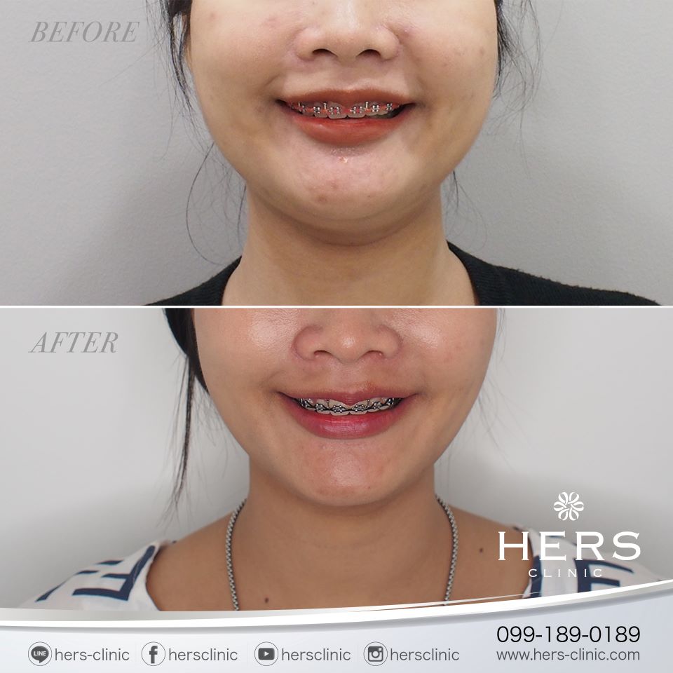ตัดไขมันกระพุ้งแก้ม ลดแก้ม หน้าเรียว Hers Clinic