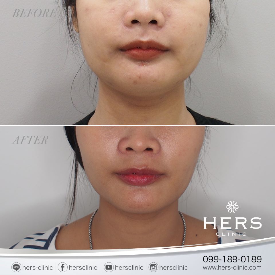 ตัดไขมันกระพุ้งแก้ม ลดแก้ม หน้าเรียว Hers Clinic