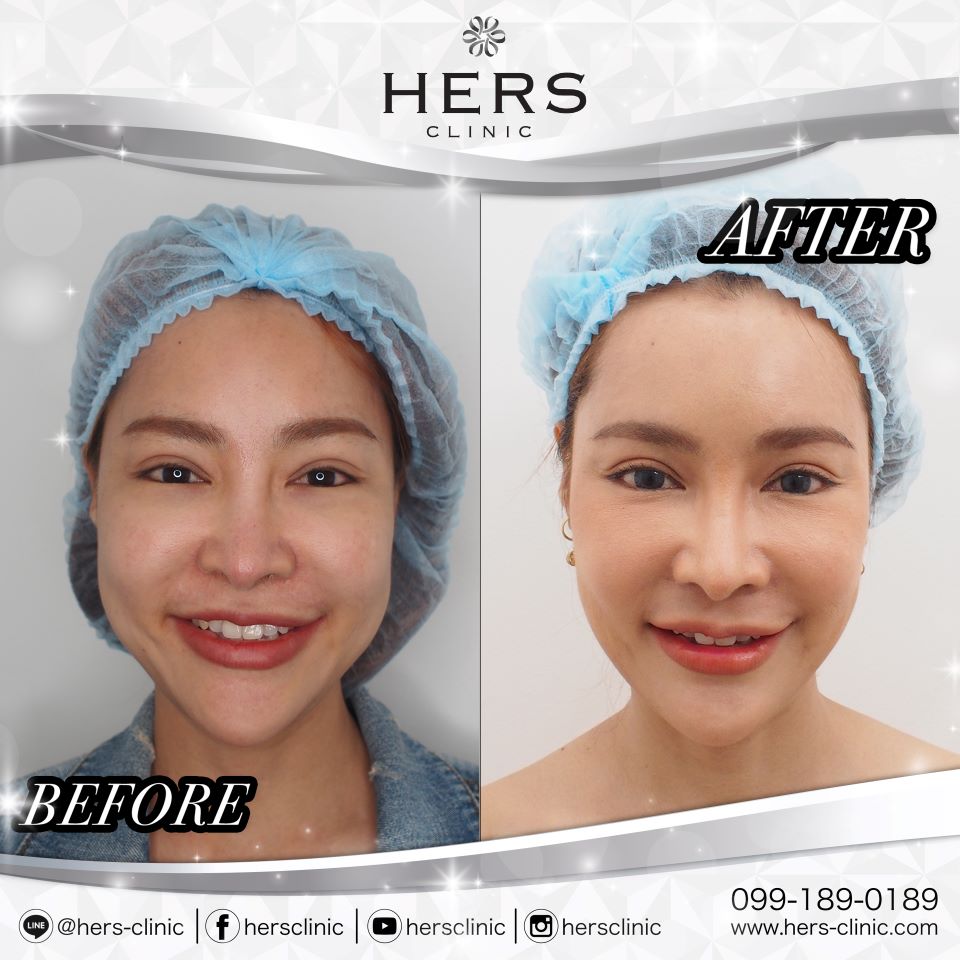 ตัดไขมันกระพุ้งแก้ม ลดแก้ม หน้าเรียว Hers Clinic