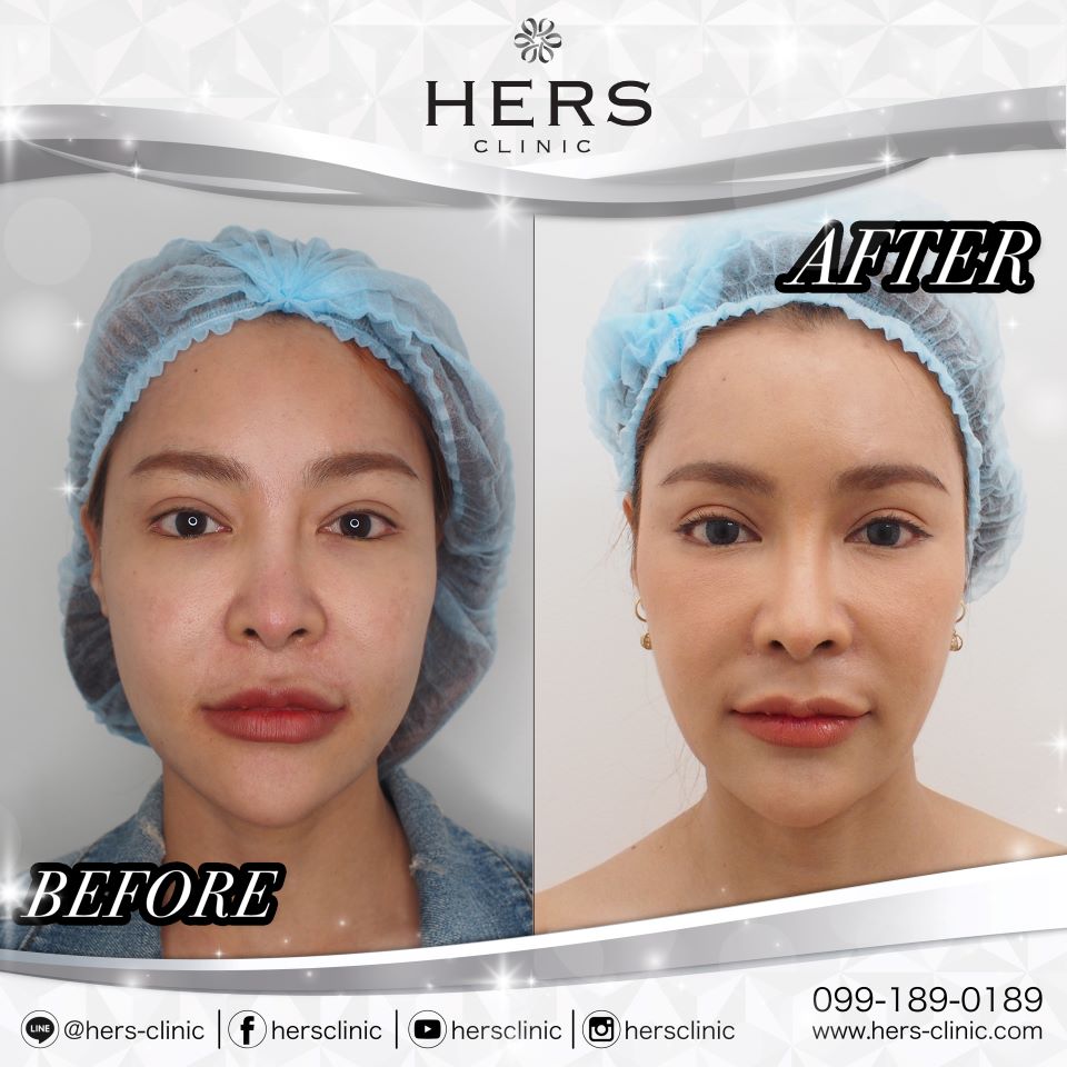 ตัดไขมันกระพุ้งแก้ม ลดแก้ม หน้าเรียว Hers Clinic