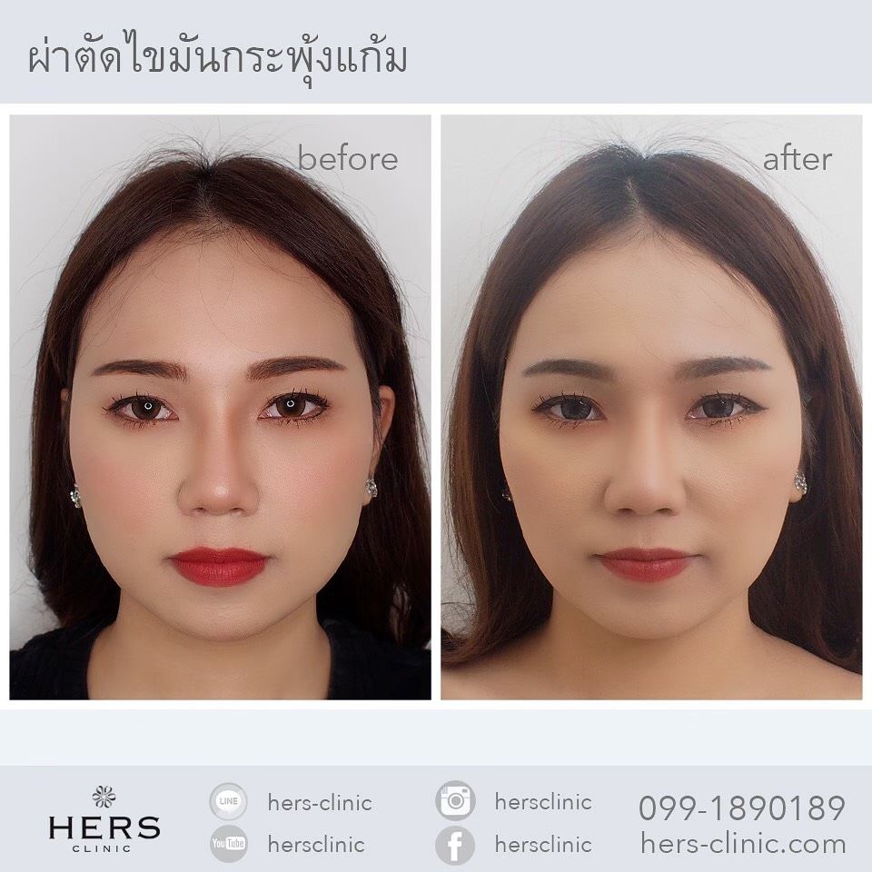 ตัดไขมันกระพุ้งแก้ม ลดแก้ม หน้าเรียว Hers Clinic