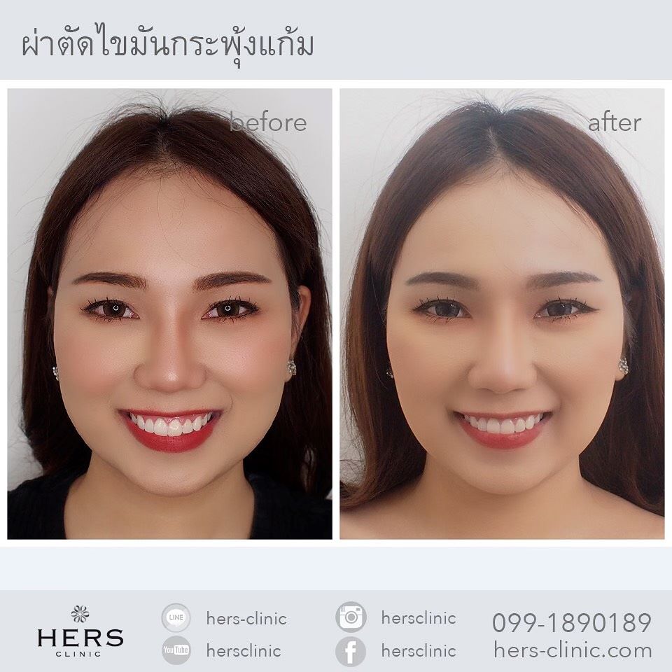 ตัดไขมันกระพุ้งแก้ม ลดแก้ม หน้าเรียว Hers Clinic
