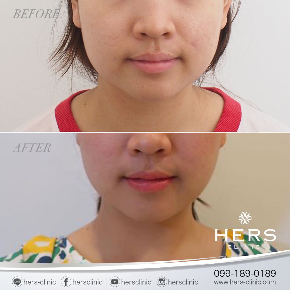 ตัดไขมันกระพุ้งแก้ม ลดแก้ม หน้าเรียว Hers Clinic