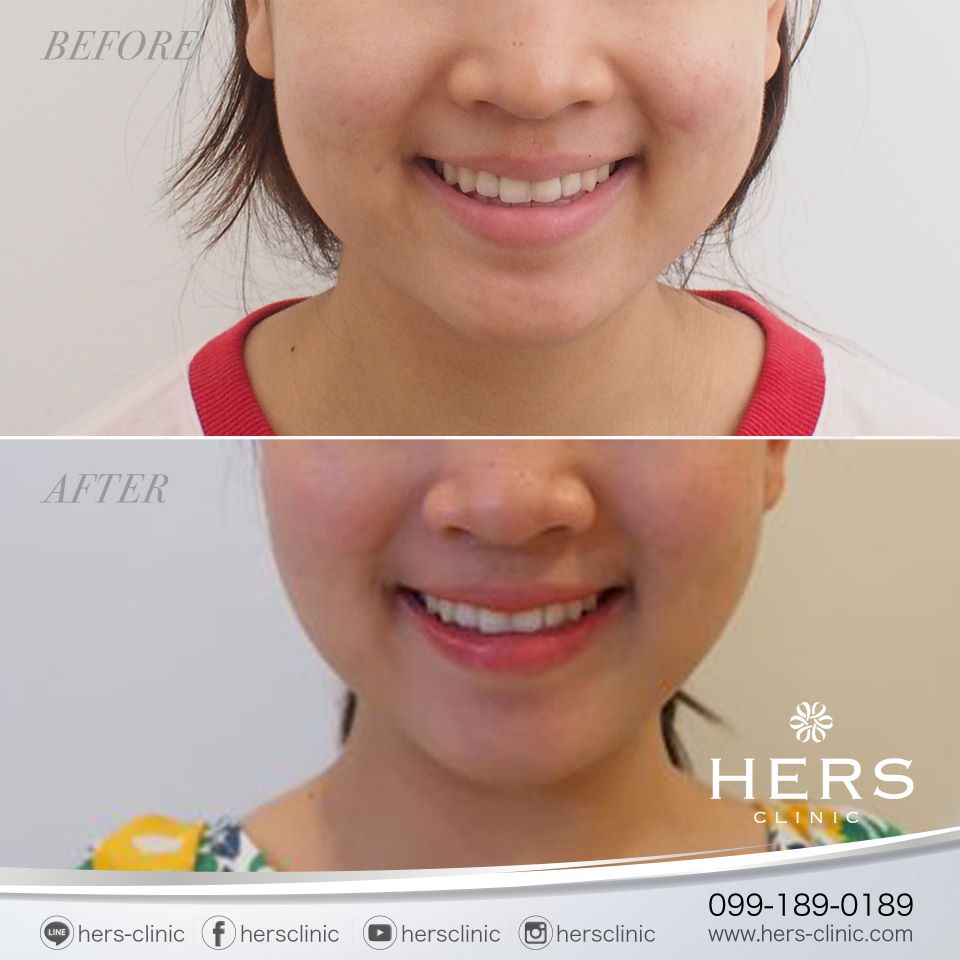 ตัดไขมันกระพุ้งแก้ม ลดแก้ม หน้าเรียว Hers Clinic