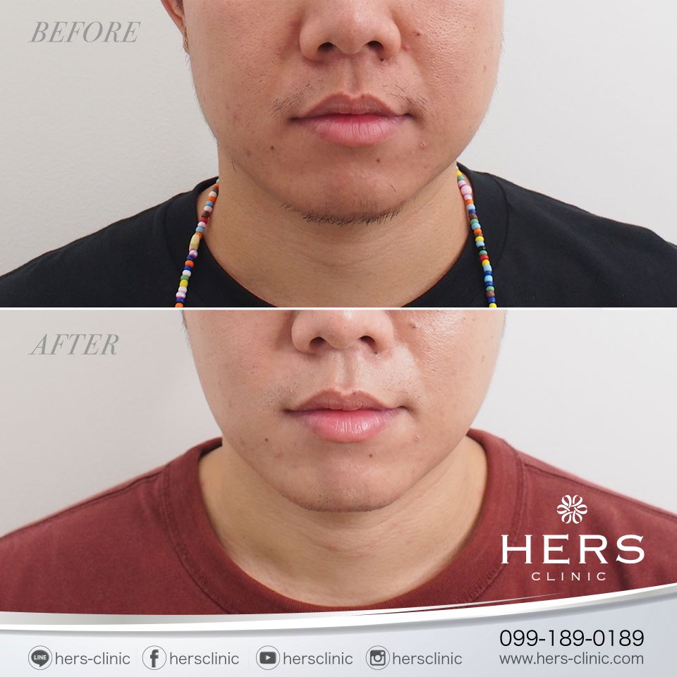 ตัดไขมันกระพุ้งแก้ม ลดแก้ม หน้าเรียว Hers Clinic