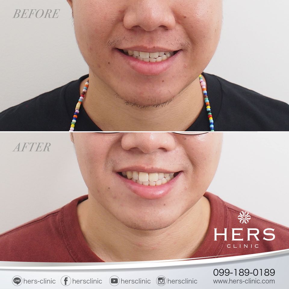 ตัดไขมันกระพุ้งแก้ม ลดแก้ม หน้าเรียว Hers Clinic