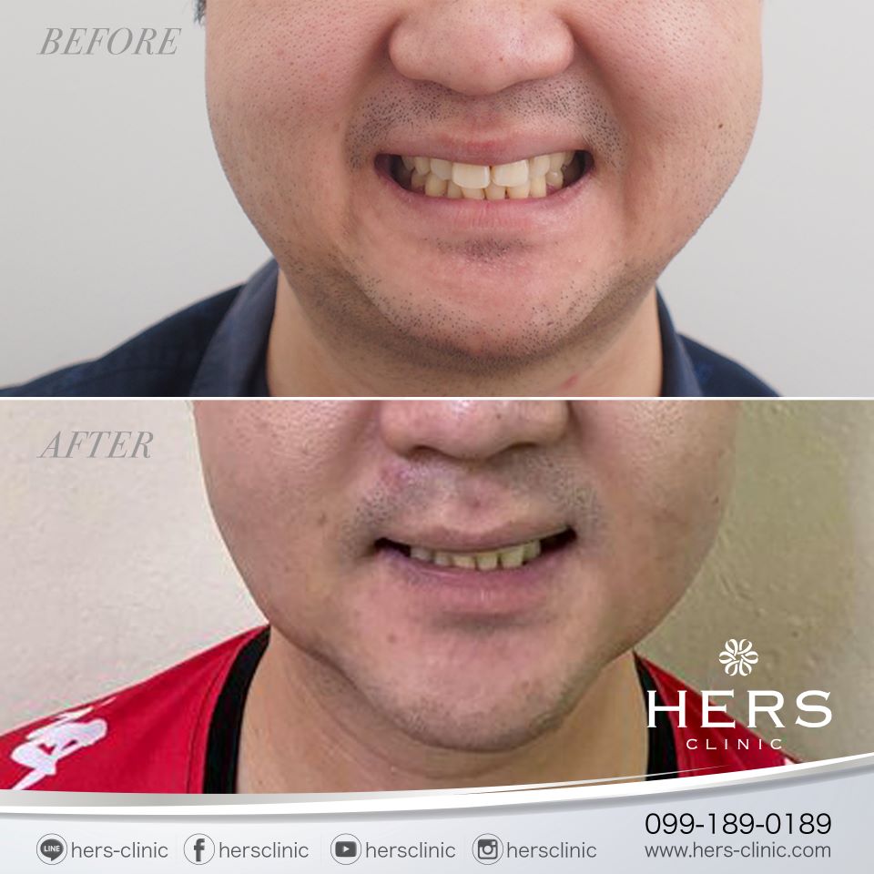 ตัดไขมันกระพุ้งแก้ม ลดแก้ม หน้าเรียว Hers Clinic
