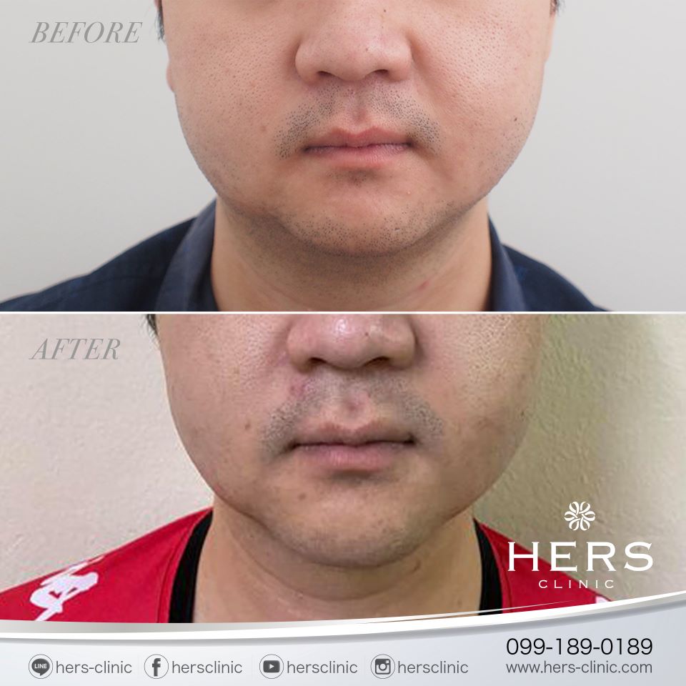 ตัดไขมันกระพุ้งแก้ม ลดแก้ม หน้าเรียว Hers Clinic