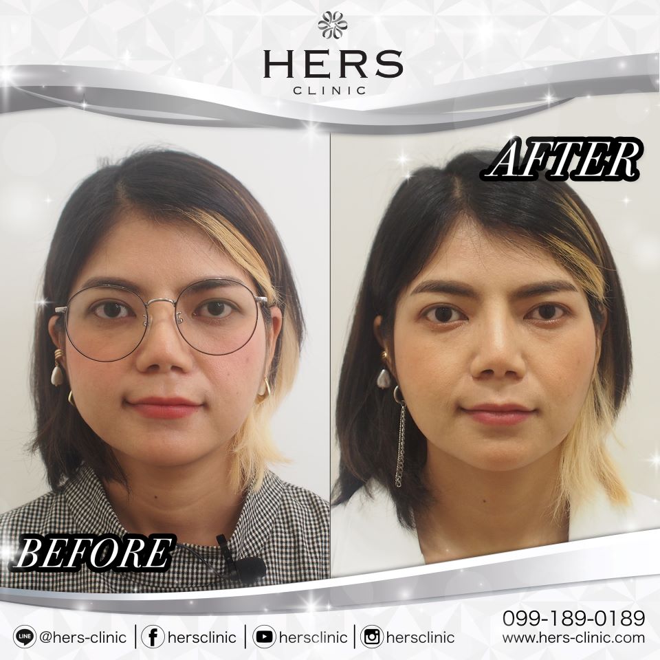ตัดไขมันกระพุ้งแก้ม ลดแก้ม หน้าเรียว Hers Clinic