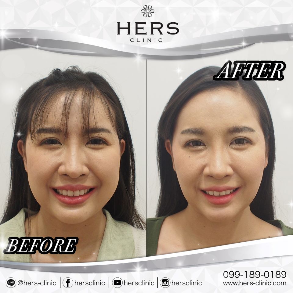 ตัดไขมันกระพุ้งแก้ม ลดแก้ม หน้าเรียว Hers Clinic
