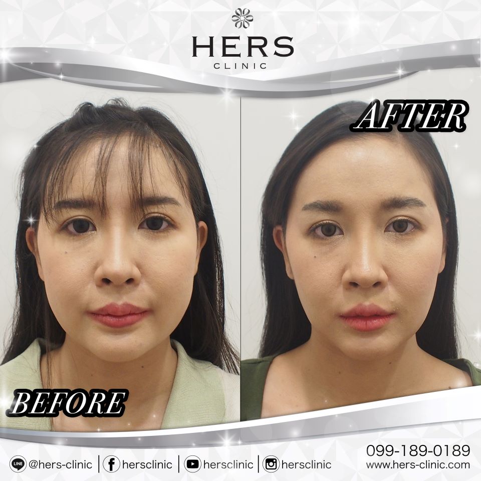 ตัดไขมันกระพุ้งแก้ม ลดแก้ม หน้าเรียว Hers Clinic